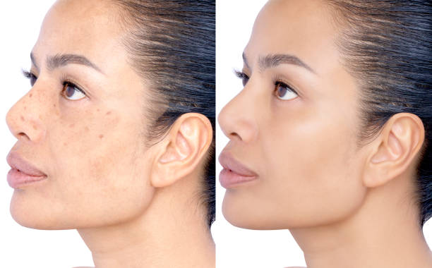 Glutathione for Skin Pigmentation
